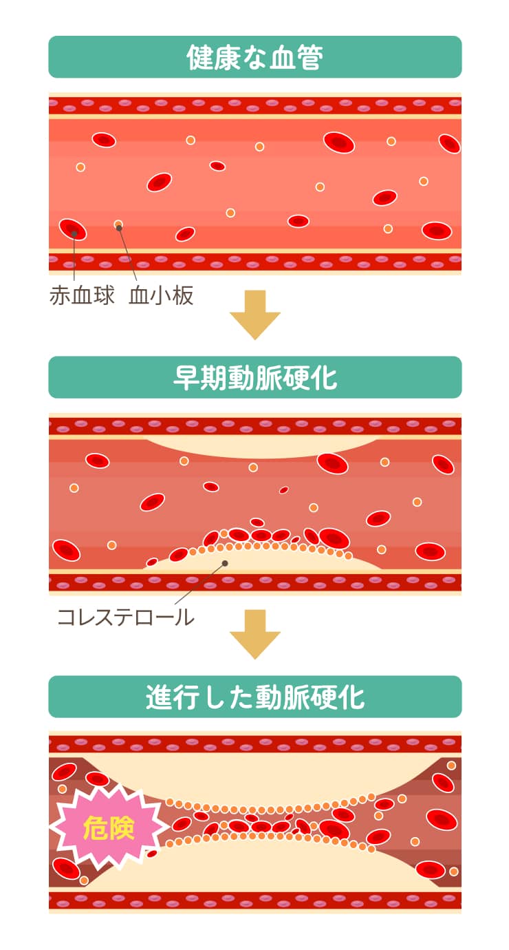 健康な血管、早期動脈硬化、進行した動脈硬化、の違い
